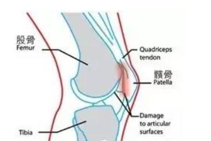 髌股疼痛综合症的评估,髌胫束综合征膝盖疼