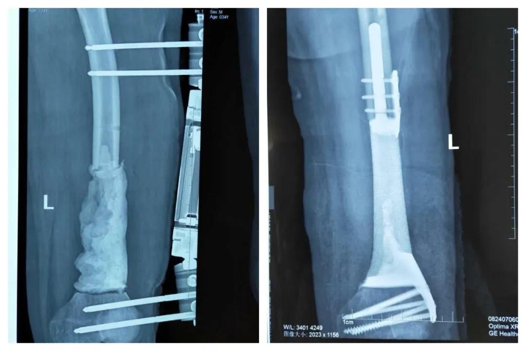 颅底骨折3d打印,3d打印技术辅助治疗胫骨平台骨折