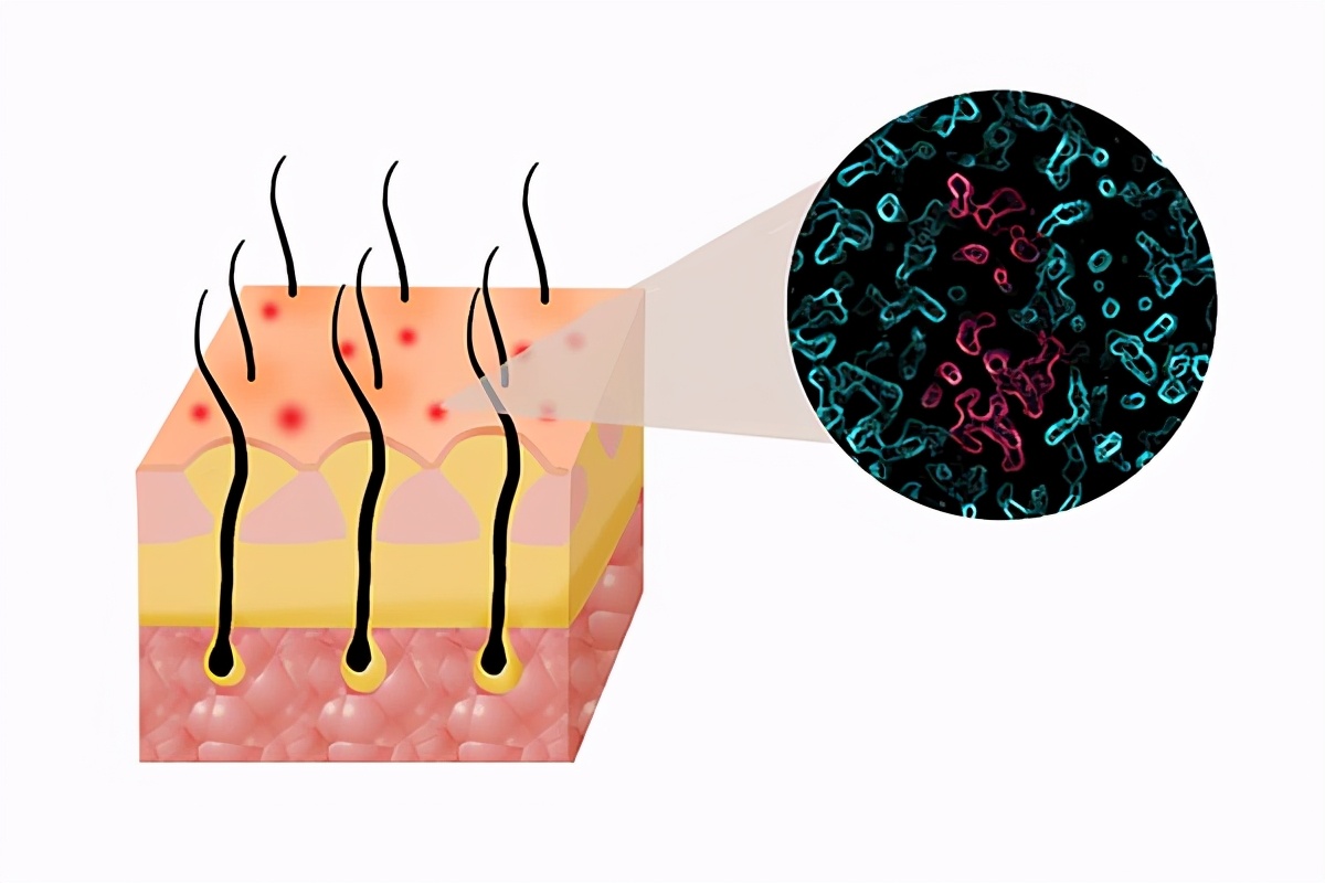 洗完头抓头皮上有白泥怎么解决,如何清洗头皮上覆盖的白泥要抠吗