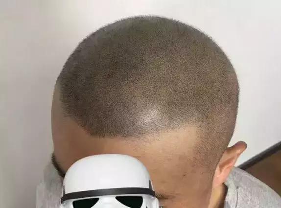 每天掉100根头发会变秃头吗,头上有多少根头发算秃头