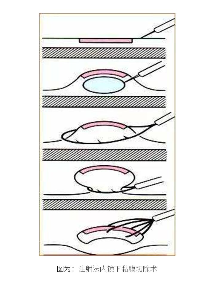 老年人肠癌要不要开刀,肠癌需不需要做靶向治疗