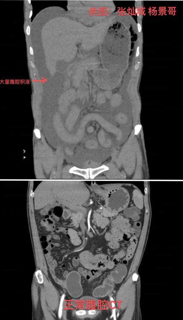 过年不就医？他腹痛忍到胃穿孔，春节险入“鬼门关”