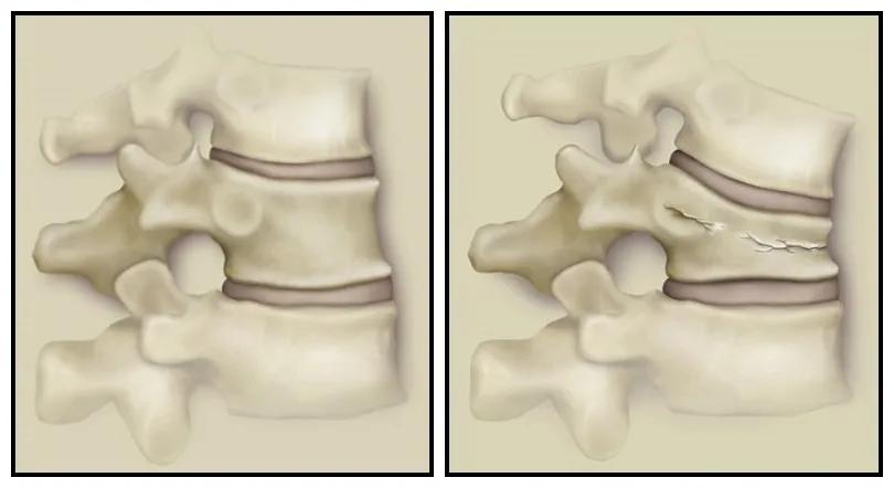 老人腰疼骨折怎么治疗,老年人腰疼怎样判断是否骨折