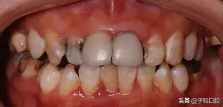一口黄牙有多尴尬,一口烂牙怎么补救