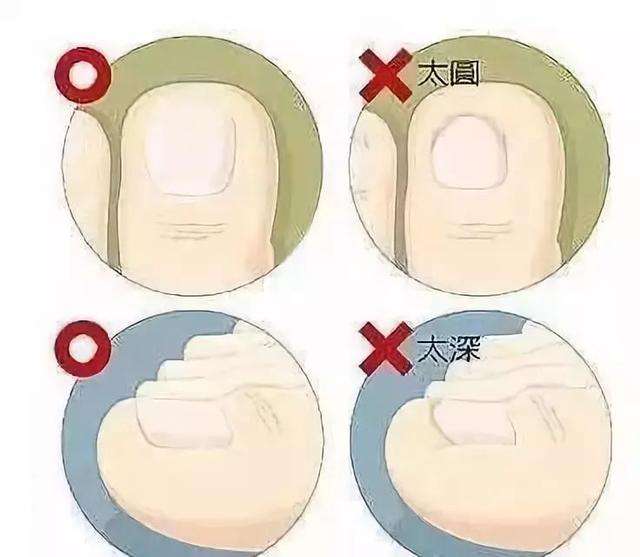 得甲沟炎最有效的处理方法是什么,甲沟炎怎么初期治疗才能彻底根除