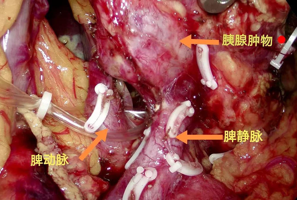 腹腔镜胰腺中段切除术的现状,腹腔镜下胰体尾部切除手术步骤