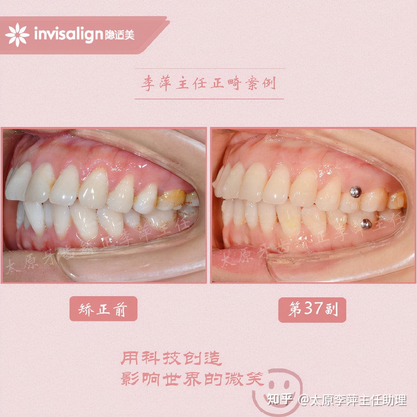 重度拥挤矫正牙齿适合隐形牙套吗,广州成人牙齿矫正推荐隐形牙套