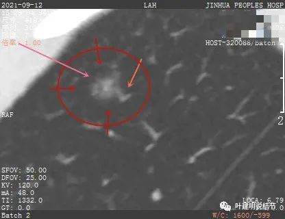 从活检怎么看是非小细胞癌,从病例谈辨证论治