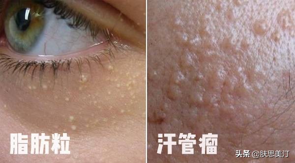 只有胖人才长脂肪粒吗,长了个很凸起的脂肪粒