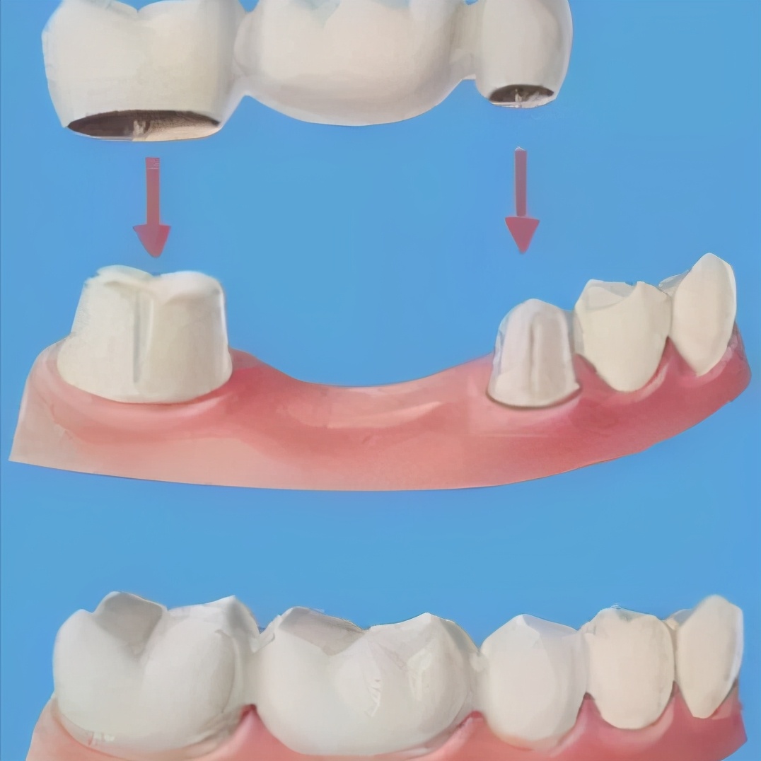 80岁老人牙齿几乎掉光了怎么镶牙,70岁老人适合哪种镶牙的方式
