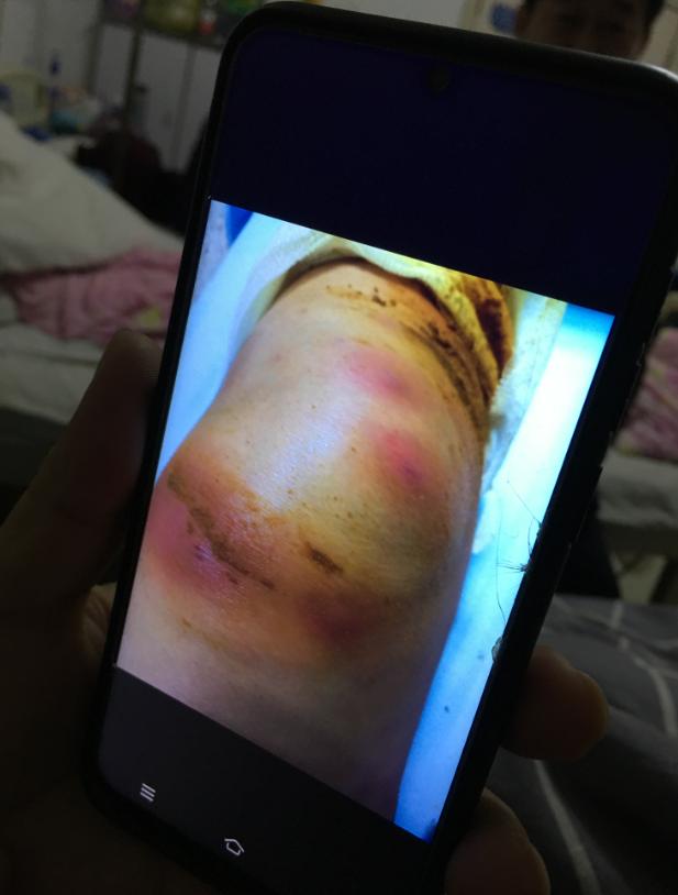 河南杞县115人针灸后针眼溃烂：针灸前被注射药物，事发后仍有人苦求继续针灸，患者需手术切开伤口排脓
