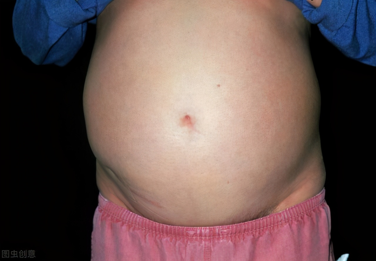 7岁小女孩肝硬化腹水，西医说要换肝，看看中医是如何治疗的