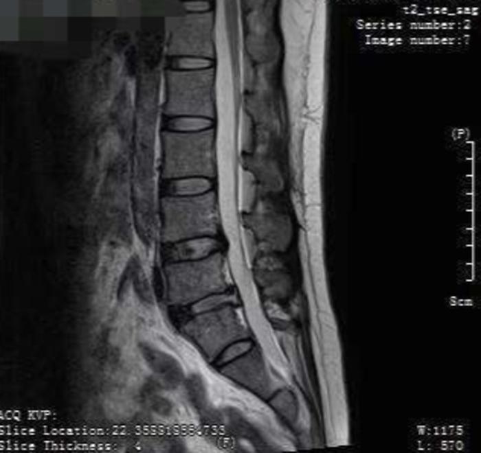 脊柱微创手术好了还能下地干活吗,微创脊柱术后康复锻炼视频
