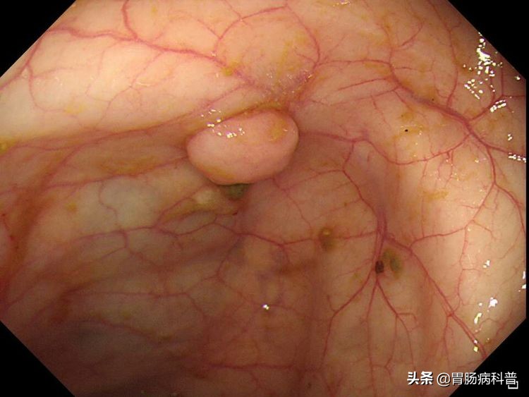 结肠癌会代代相传吗,结肠癌肝转移
