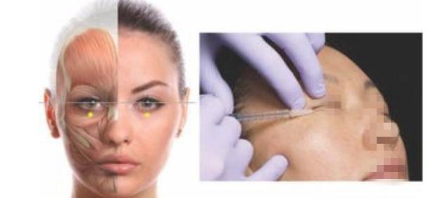 玻尿酸需要每年都打吗,打一次玻尿酸脸会变僵吗