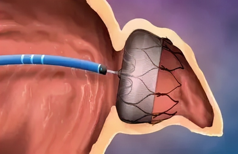 心房颤动会引起头部发麻,突发心房颤动与高血压的关系