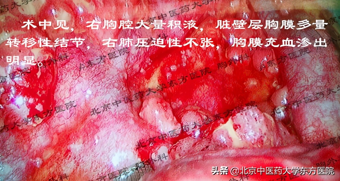 北京治疗胸腔积液哪个医院权威,中医治疗心脏胸腔积液