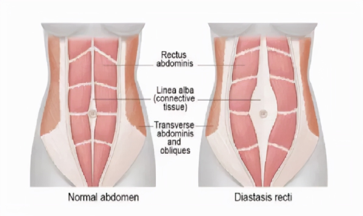 产后九年了漏尿能修复吗,产后修复做完还漏尿怎么回事