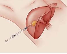 乙肝病人转氨酶高对肝有什么影响,慢性乙肝引起转氨酶高200
