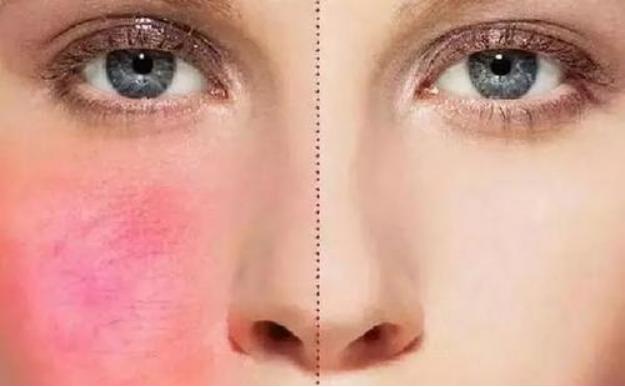 脸上有瑕疵是红血丝吗,怎么判断脸上有红血丝