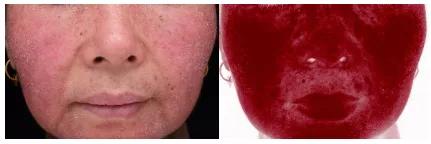 脸又痒又红又起痘,敏感皮肤脸发红发烫怎么办