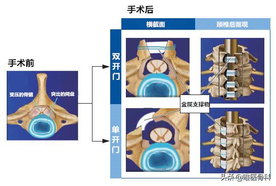 乳腺微创手术和开放手术的区别,开放手术和微创手术的区别