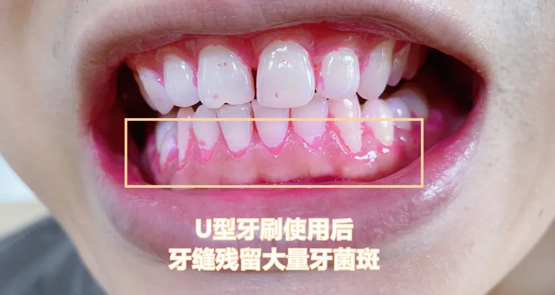 最近风很大的儿童U型牙刷，我劝你直接退出母婴产品界吧