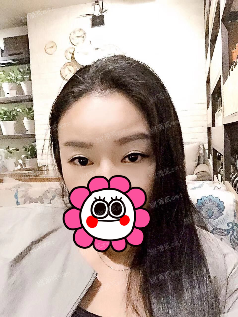 提肌矫正失败的表现眼皮睁不开,做完提肌眼睛前半段下垂