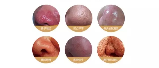 酒糟鼻如何应对,酒糟鼻是常见的美容病该如何应对