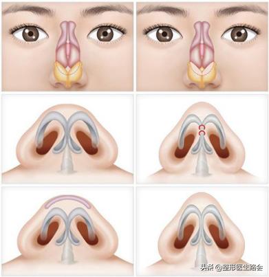 如何正确有效的缩小鼻翼,鼻翼大怎么缩小手术风险大吗
