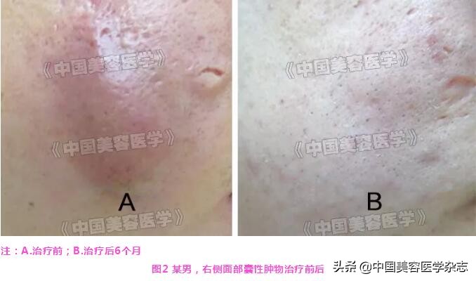 射频火针治疗囊肿痘痘过程,电针治疗仪对囊肿有效吗