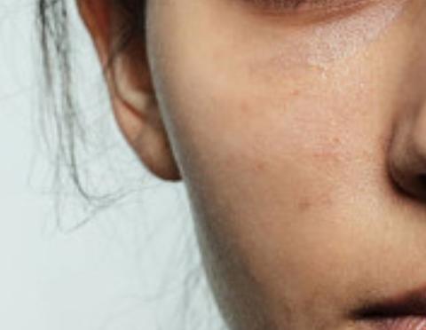 红色痘印黑色痘印痘坑区别,红痘印淡化最快的方法