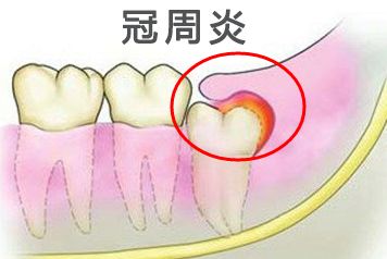 用于牙痛的消炎镇痛药有哪些,止痛药对牙痛有效吗