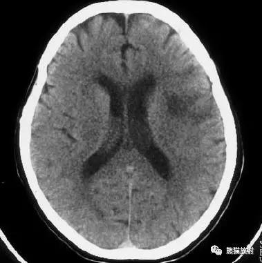 各部位脑梗死ct影像讲解,脑梗死ct影像最简单的是什么表现