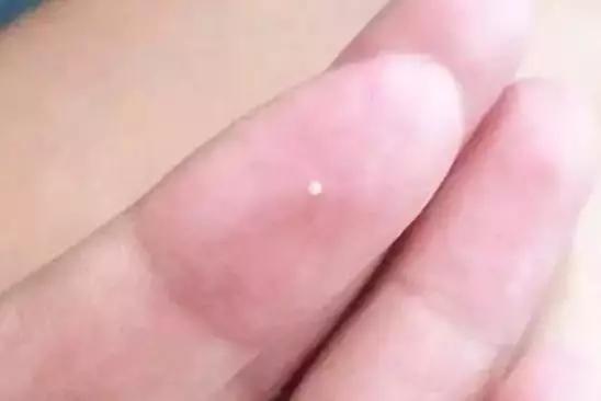 眼周脂肪粒可以激光去除吗,眼周脂肪粒会自动消失吗