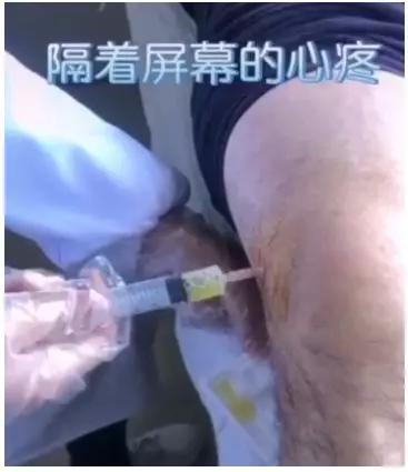 隔着屏幕的心疼!医生抽出民警膝盖里的积液,都已经化脓了
