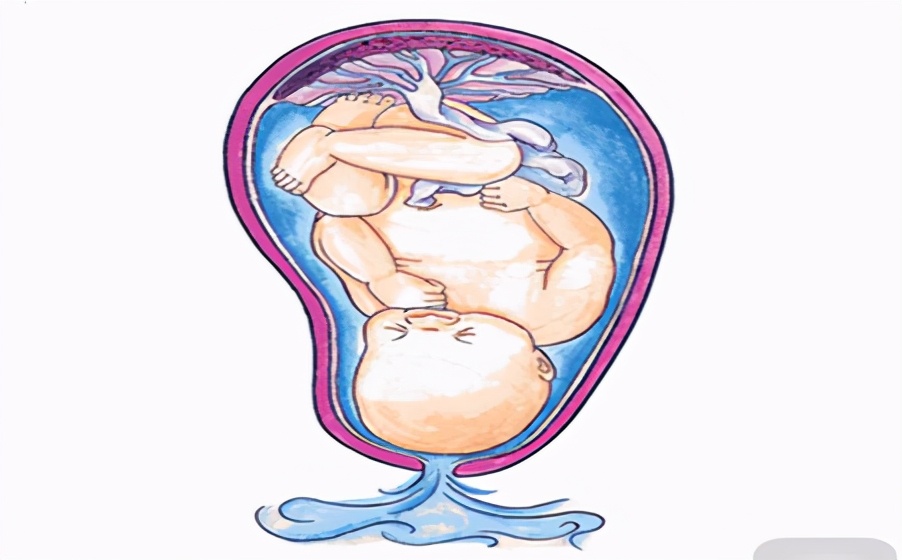 孕妇破水了怎么办，不要慌张，先做好自行处理