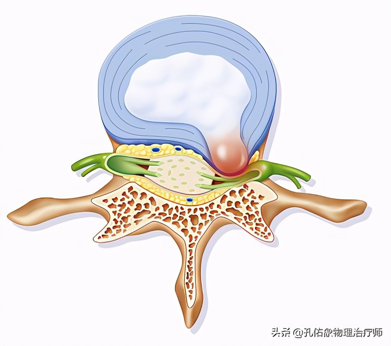 颈椎间盘突出手指尖麻乏力怎么治,颈椎间盘突出导致四肢无力疼痛