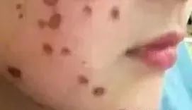 做激光大概多少钱,激光费用大概是多少