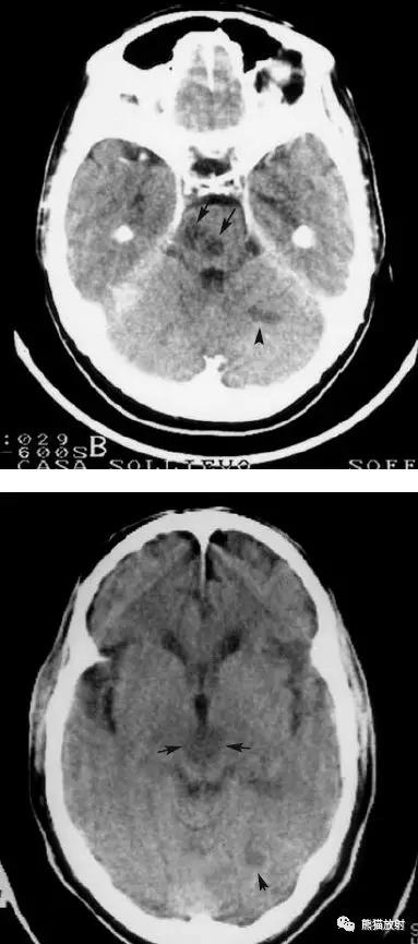 各部位脑梗死ct影像讲解,脑梗死ct影像最简单的是什么表现