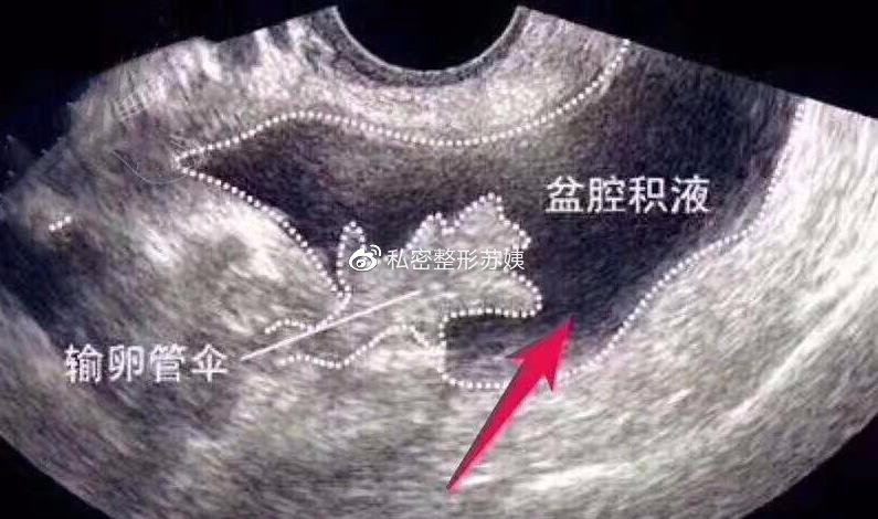 什么是盆腔积液？盆腔积液需要治疗么？一文解读误区