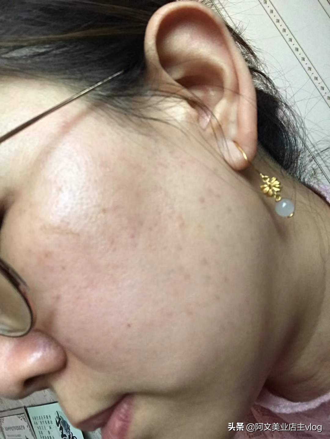 阿文讲她的青春痘扁平疣历史，分享护肤小知识