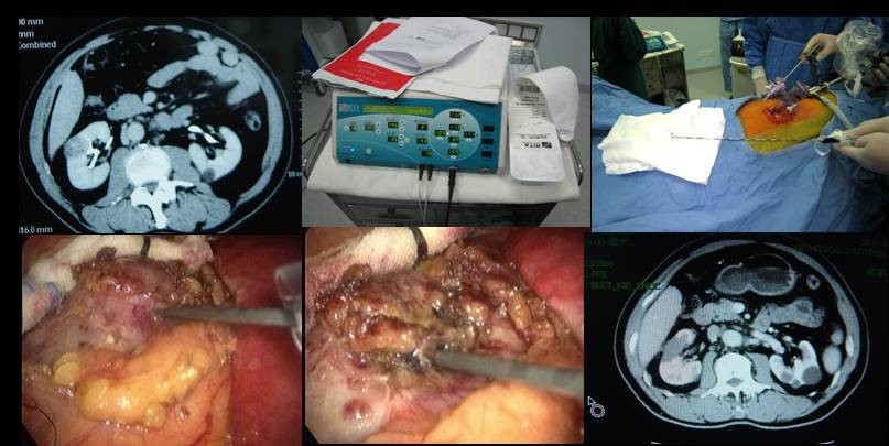 射频消融治疗肿瘤效果怎样,肝脏射频消融对肾脏有损伤吗