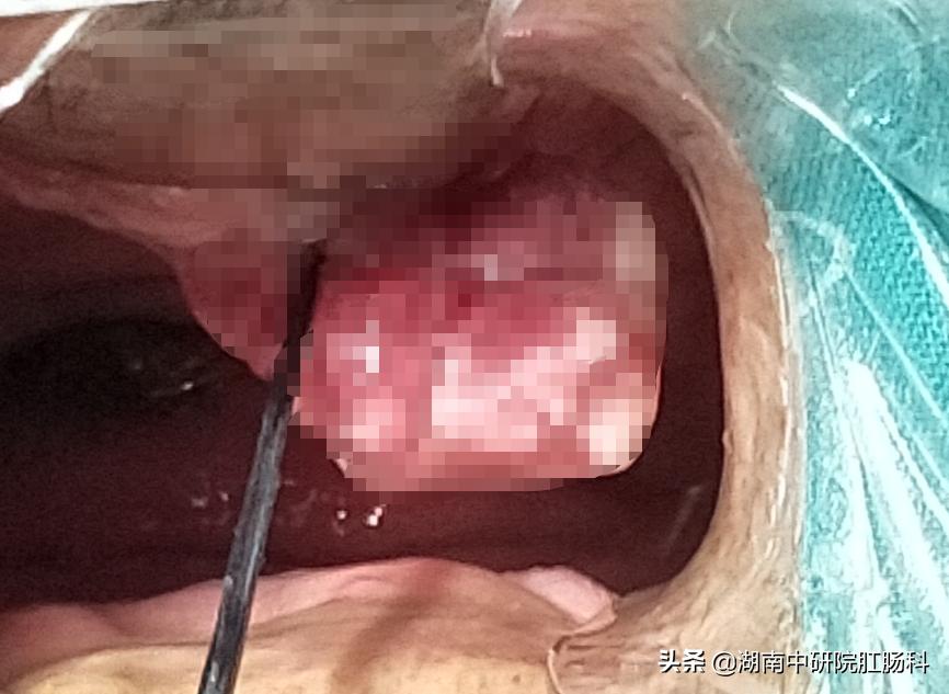 低位直肠癌早期能保肛吗,低位直肠癌晚期治愈吗