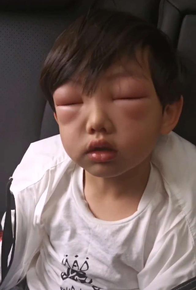 孩子是过敏体质家长可要注意了,过敏体质的娃长大后