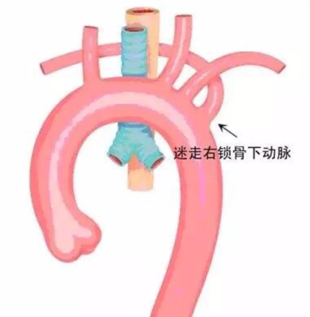 胎儿右锁骨下动脉迷走是心脏病吗,胎儿右锁骨下动脉迷走要做无创吗