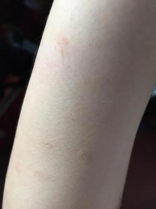 一般得了梅毒以后还能治好吗？