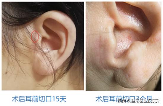 面部五层提升术视频,面部五层提升方法直播