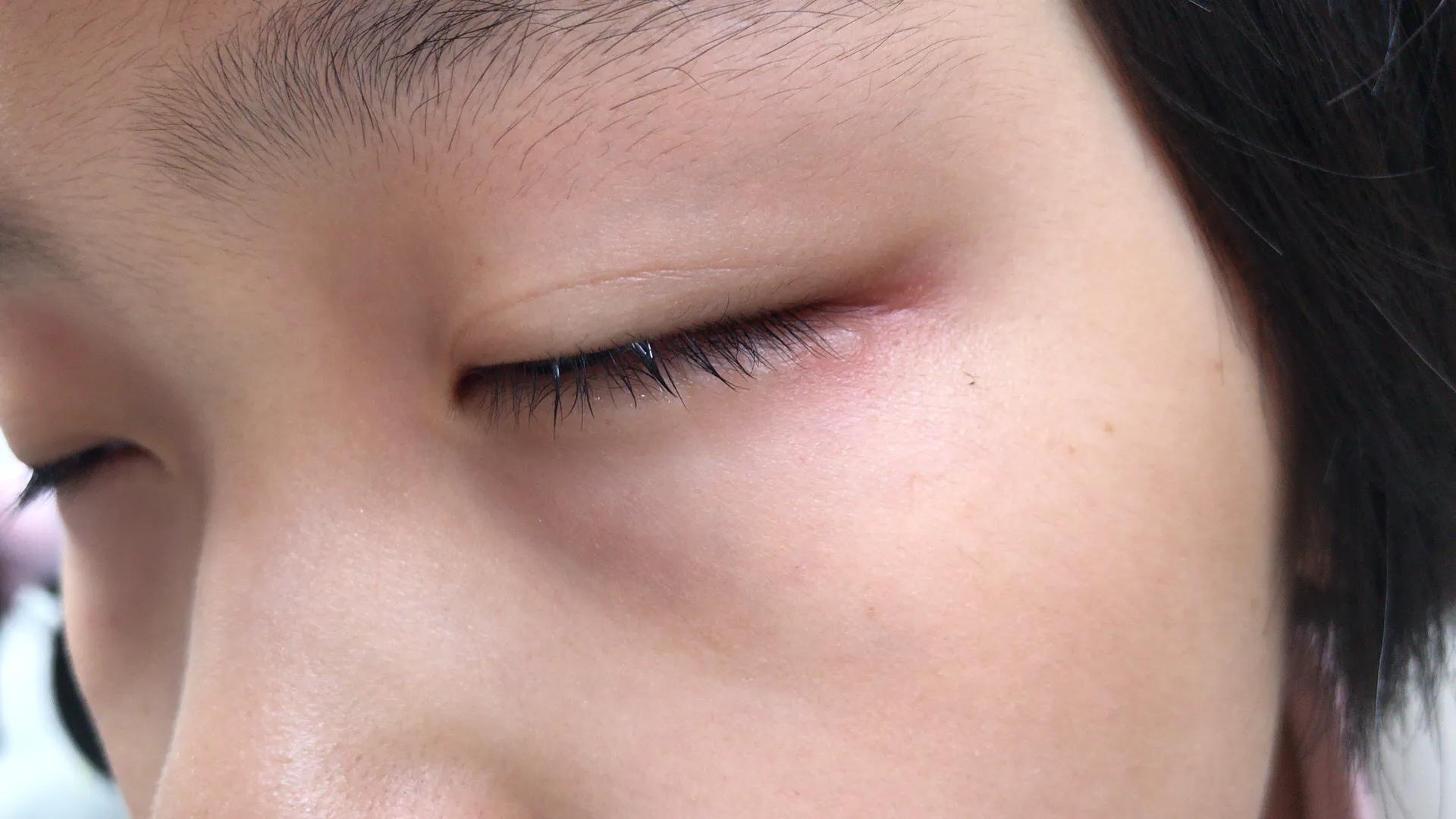 儿童发烧吃美林过敏什么原因,儿童发烧喝美林浑身起疙瘩