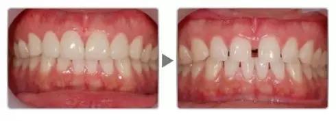 两门牙中间的缝隙越来越大,为什么门牙缝隙大这么难看